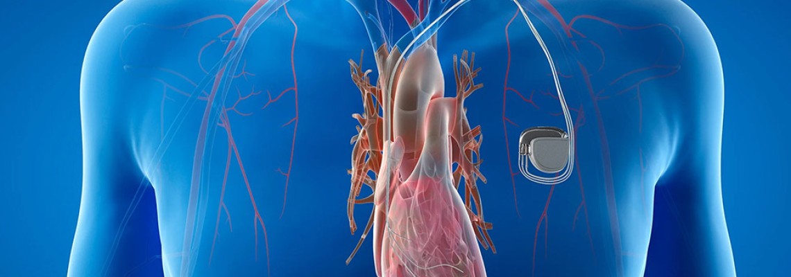 The impact of magnetic fields on pacemakers